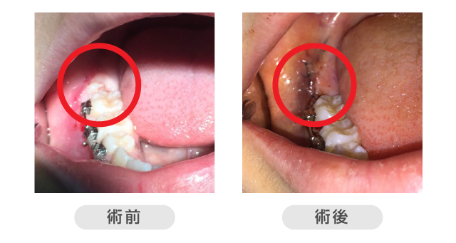 親知らず治療の術前・術後